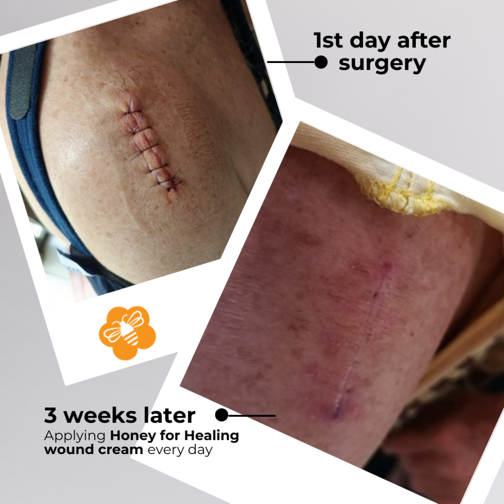 Honey for Healing® Powerful Manuka Wound Cream - Image 10