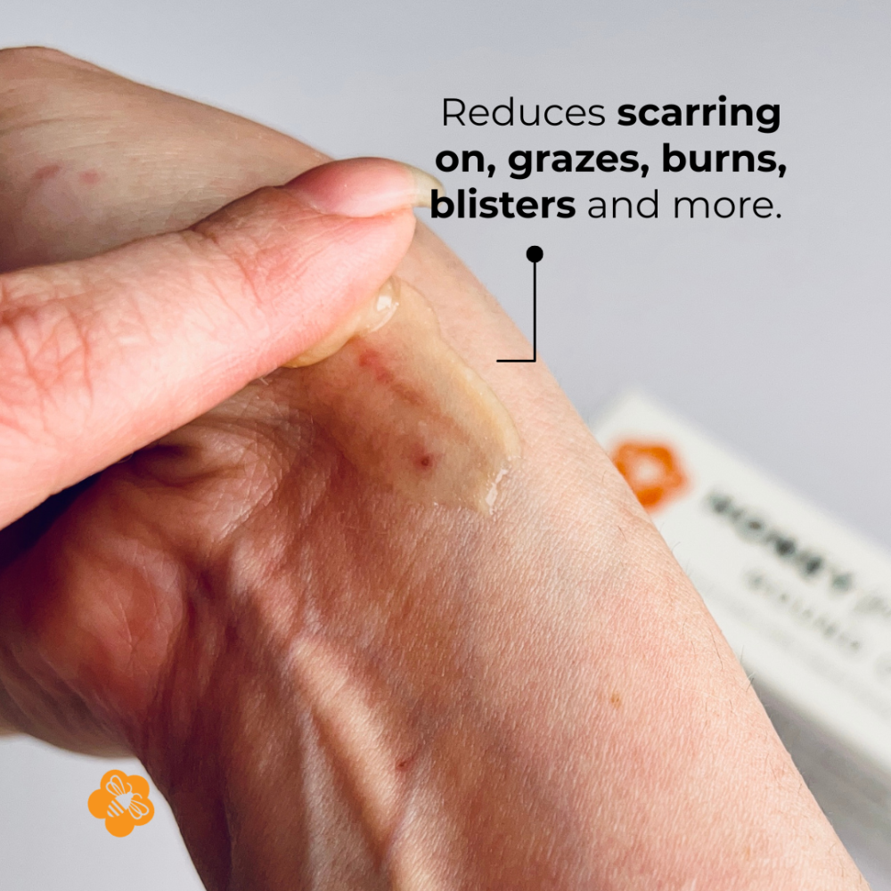 Honey for Healing® Powerful Manuka Wound Cream - Image 4