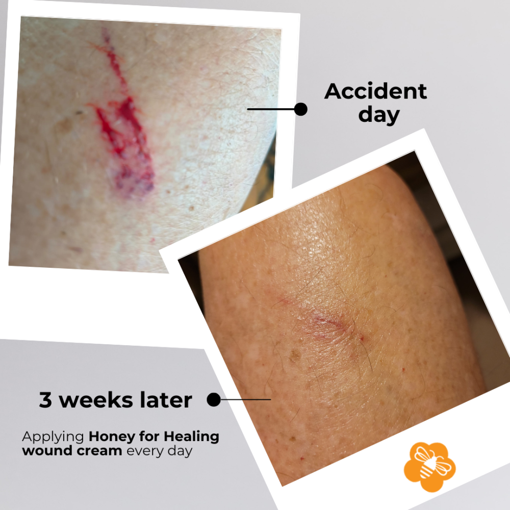 Honey for Healing® Powerful Manuka Wound Cream - Image 9